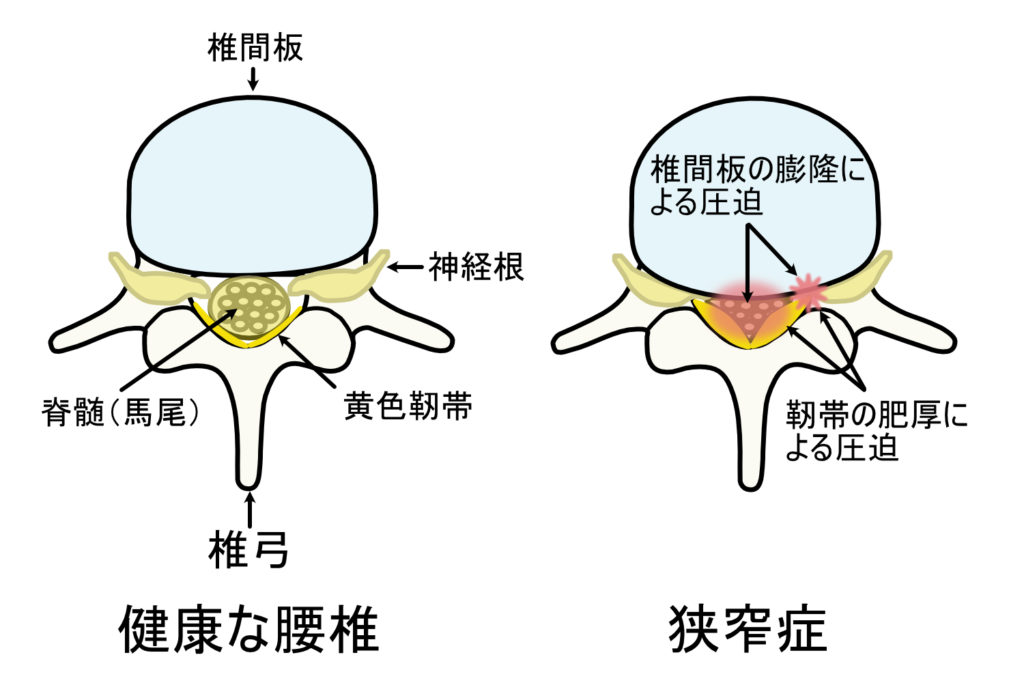 腰部脊柱管狭窄症の図解